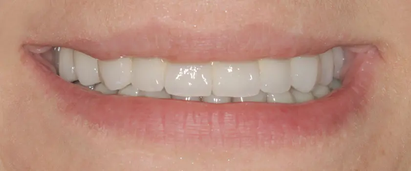 O nama - Prije i poslije | Štimac Centar dentalne medicine | Studije slučaja | IMPLANTATI