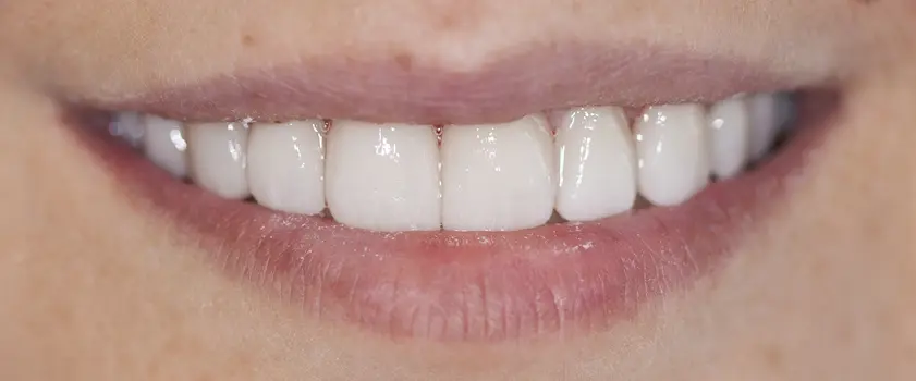 O nama - Prije i poslije | Štimac Centar dentalne medicine | Studije slučaja | IZBJELJIVANJE ZUBI