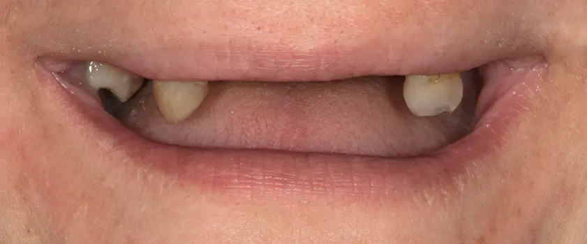 O nama - Prije i poslije | Štimac Centar dentalne medicine | Studije slučaja | IMPLANTATI