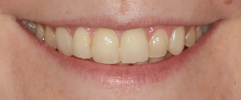 O nama - Prije i poslije | Štimac Centar dentalne medicine | Studije slučaja | IZBJELJIVANJE ZUBI