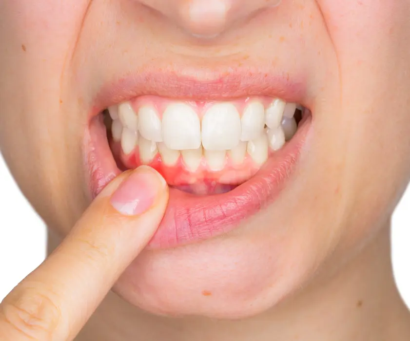 Parodontoza - Parodontologija Zagreb | Štimac centar dentalne medicine | Parodontologija | Stomatološka poliklinika Zagreb | Štimac centar dentalne medicine