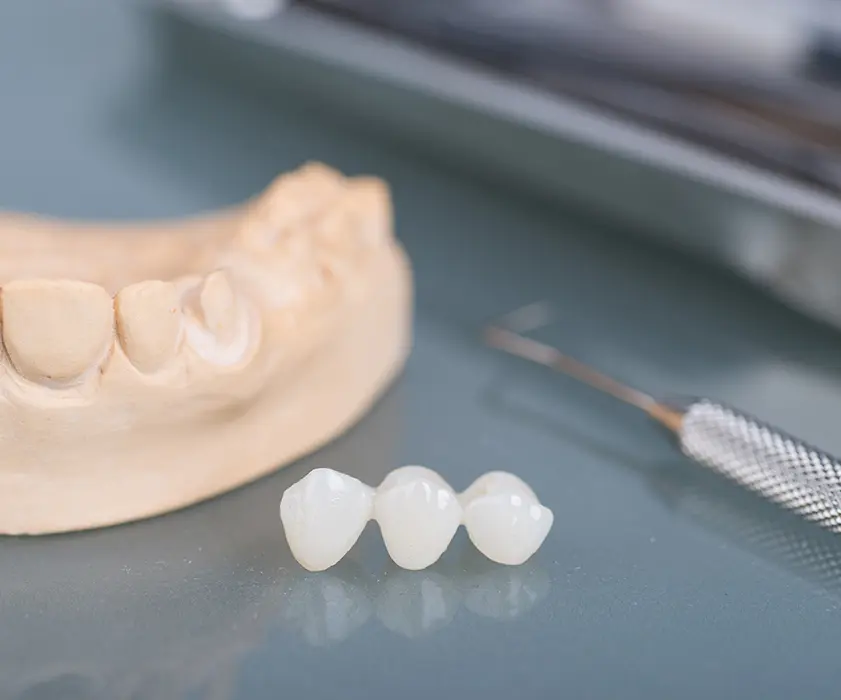 Zubni mostovi u Hrvatskoj | Stomatološka poliklinika Zagreb | Štimac centar dentalne medicine