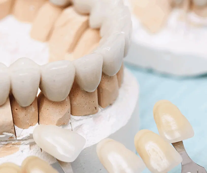 Zubni most | Cijena i ugradnja | Štimac centar dentalne medicine | Zubni mostovi | Stomatološka poliklinika Zagreb | Štimac centar dentalne medicine